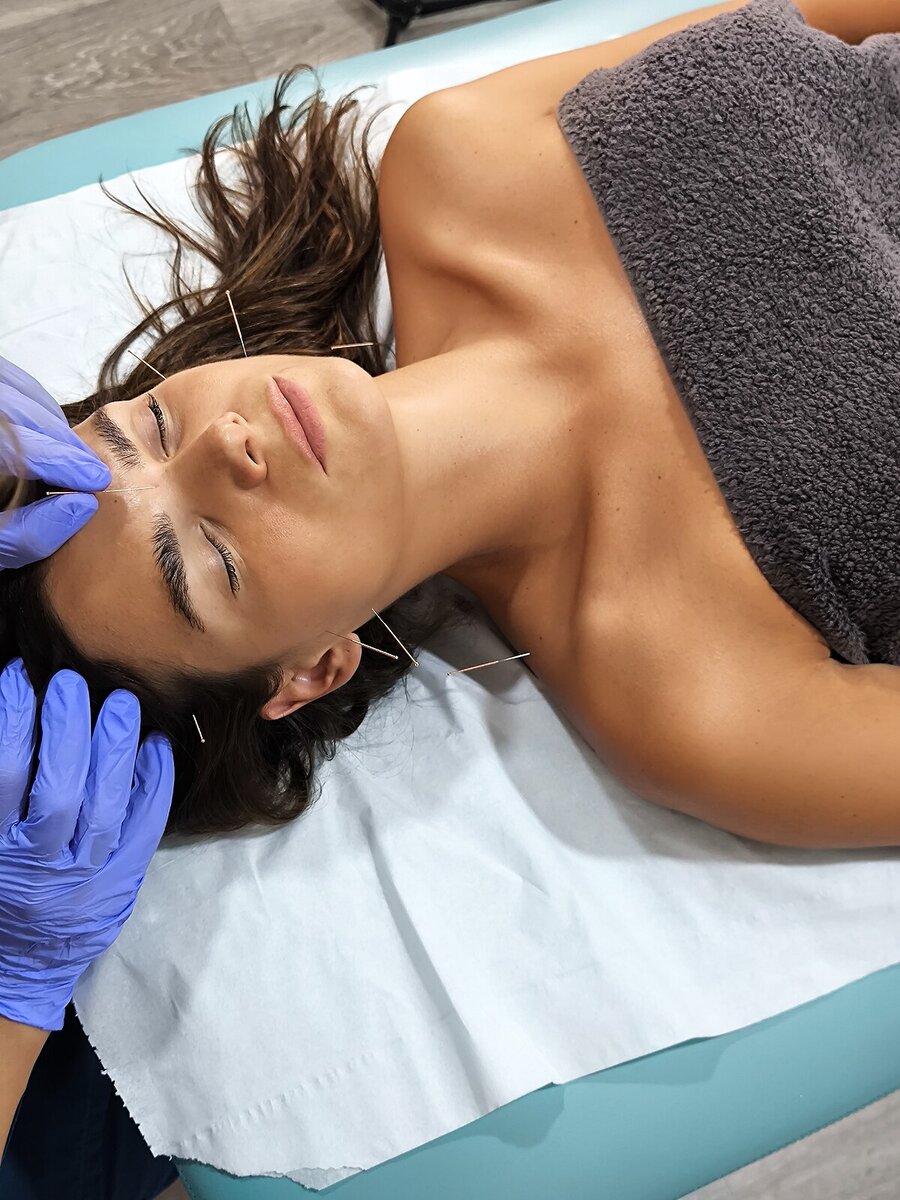 Punción seca en musculatura temporal, mandibular y cervical durante una sesión de fisioterapia orofacial